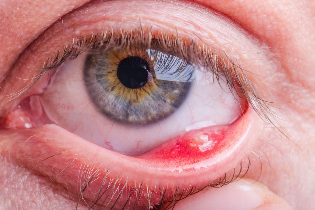 What Causes Cysts on the Eye and How They Are Treated Cysts on the Eye