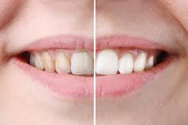 Exploring Teeth Whitening Options Teeth Whitening