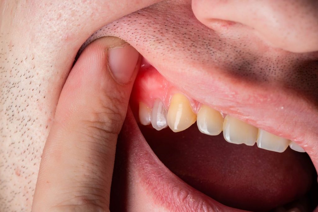 Gum Disease Affects Overall Health