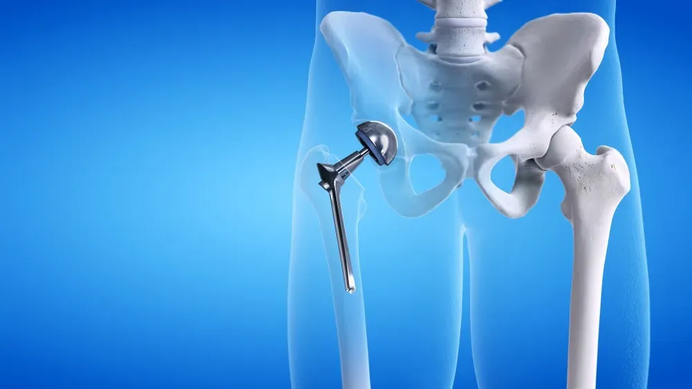 Latest Trends in Hip Replacement Technology and Outcomes Hip Replacement Technology and Outcomes