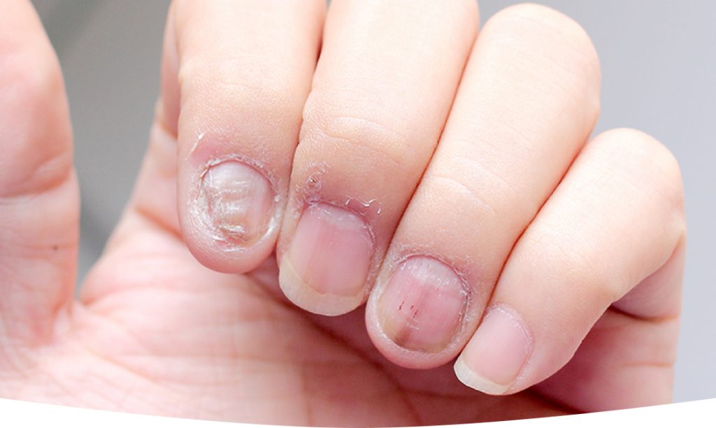 How to Identify and Treat Fungal Nails Early Identify and Treat Fungal Nails Early