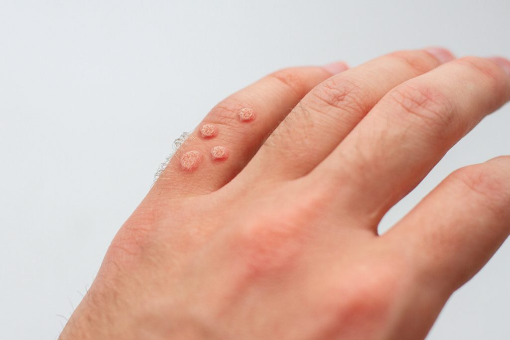 Who Should I See if I have Warts?