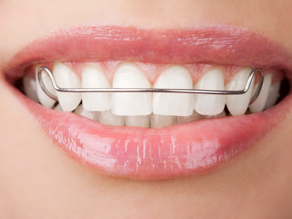 Why Retainers are Beneficial After Completing Orthodontic Treatment Why Retainers are Beneficial